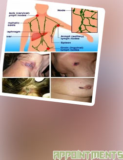 Lymphoma massage near me